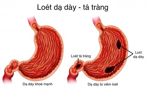 Nhận Biết 5 Dấu Hiệu Loét Dạ Dày Tá Tràng